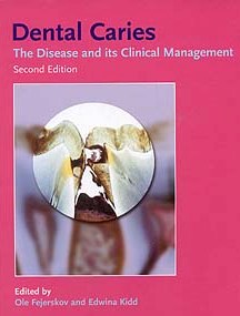 Dental Caries Book