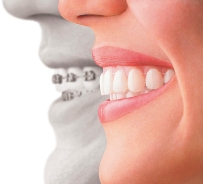 Invisalign Smile